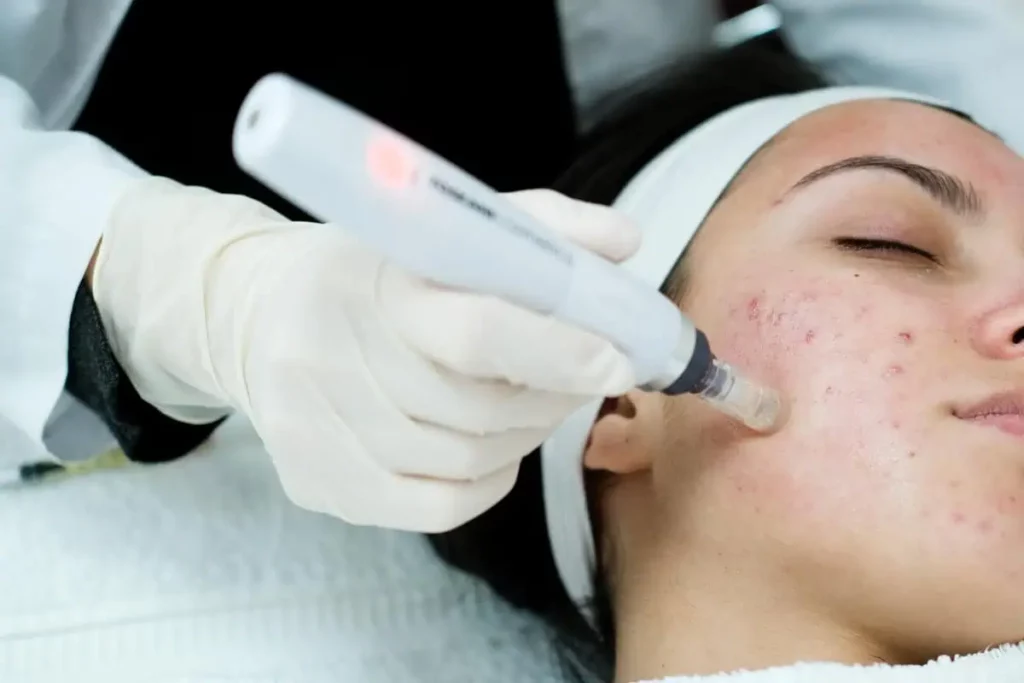 Microneedling in Rejuvé Wellness and Aesthetics