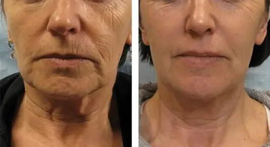 before-after-img