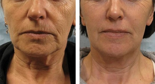 before-after-img