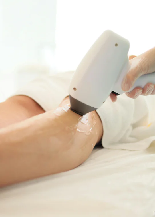 laser hair removal