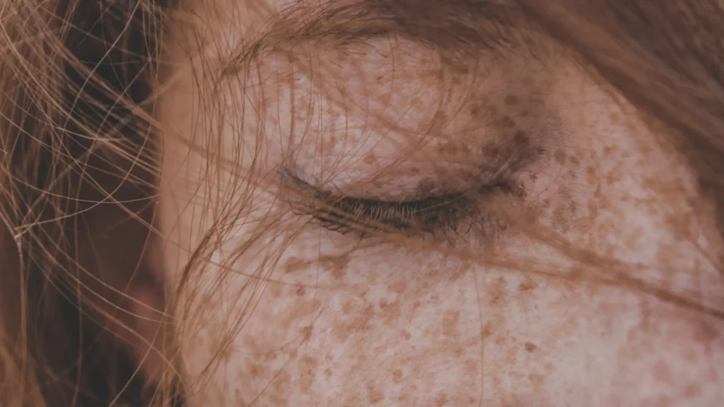 Crepey Eyelid Skin Making You Look Tired_ How Tixel Treats the Delicate Eye Area