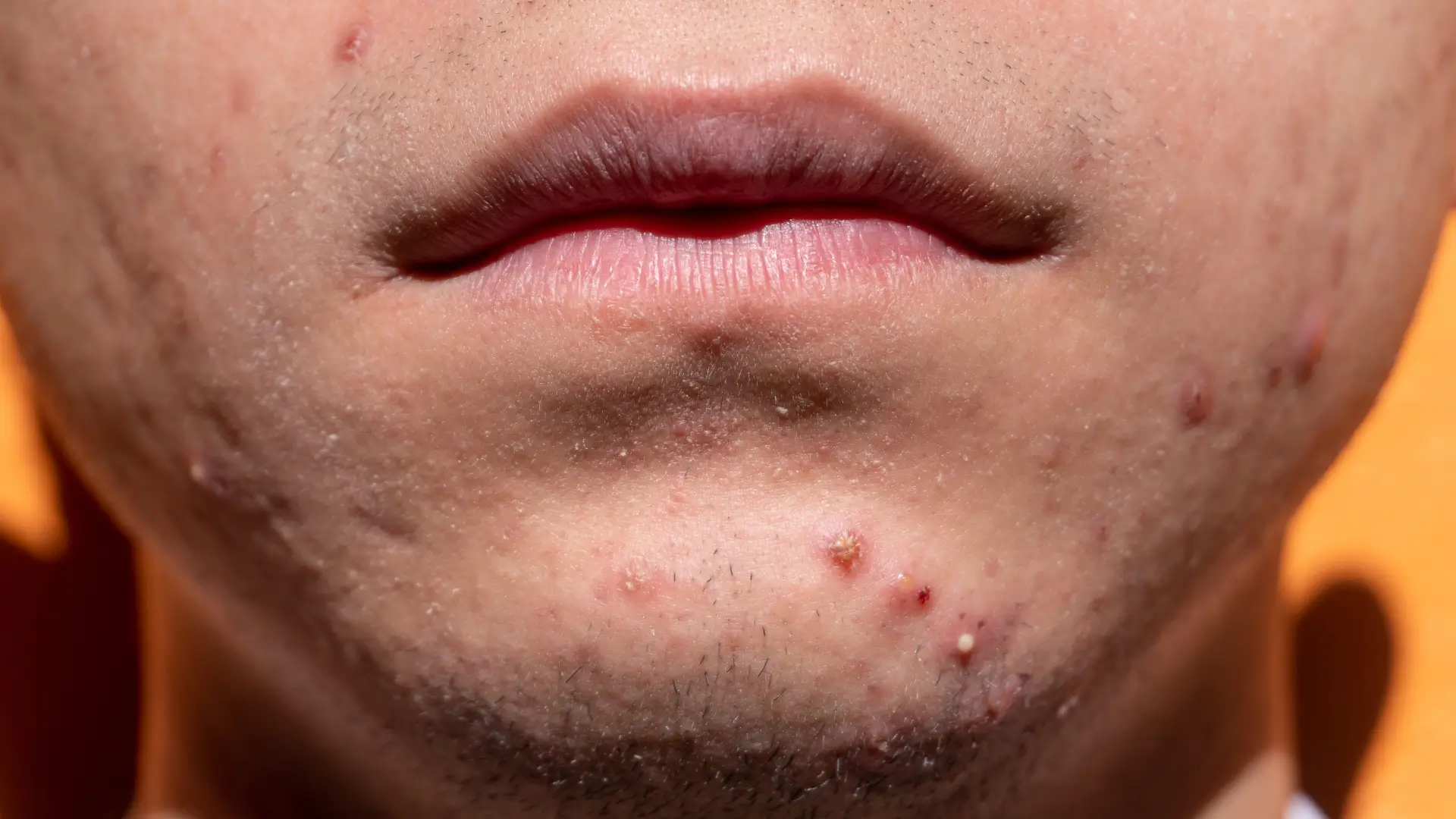 Stretch Marks Nothing Seems to Touch_ How Microneedling Helps Improve Their Look